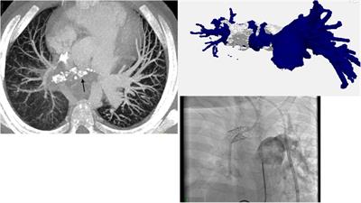 Case report: Central venous catheter thrombosis complicated by chronic thromboembolic disease/pulmonary hypertension in two children requiring parenteral nutrition